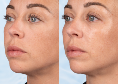 babyGLOW™: IL NUOVO TRATTAMENTO FIRMATO TEOXANE